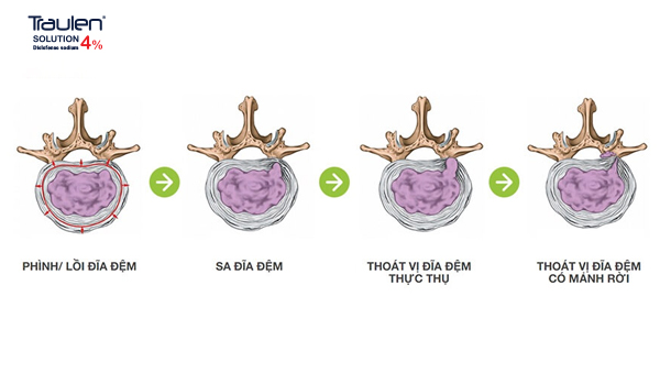 Đau thoát vị đĩa đệm - Nguyên nhân và cách điều trị
