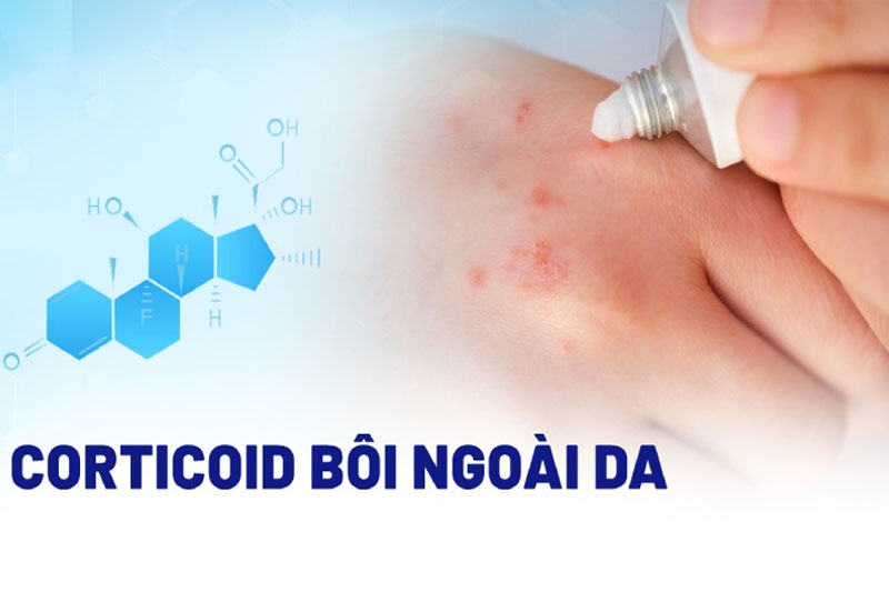 Corticoid là nhóm thuốc điều trị nhiều bệnh lý khác nhau nhờ tác dụng chống dị ứng, ức chế hệ miễn dịch và chống viêm