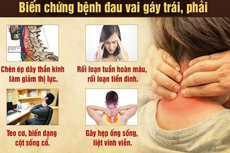 Nếu không phát hiện và điều trị kịp thời, tình trạng đau vai gáy có thể dẫn tới nhiều biến chứng phức tạp