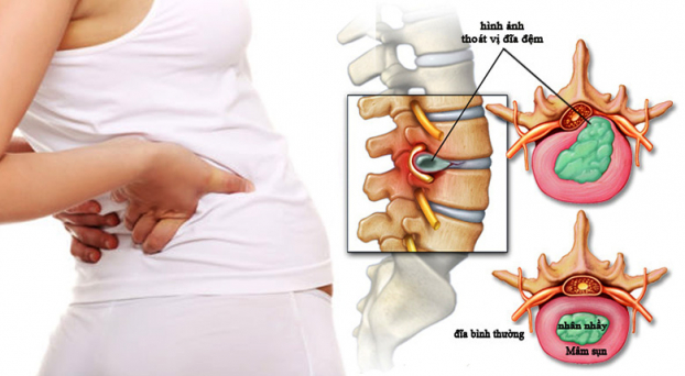 Các triệu chứng thoát vị đĩa đệm lưng (đau lưng khi cúi người hay hắt hơi, đau thần kinh tọa,…) dần trở thành nỗi ám ảnh của nhiều người